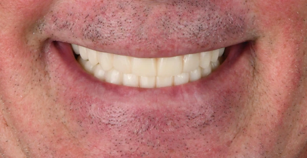 Full Mouth Reconstruction