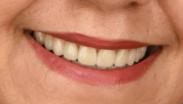 Veneers