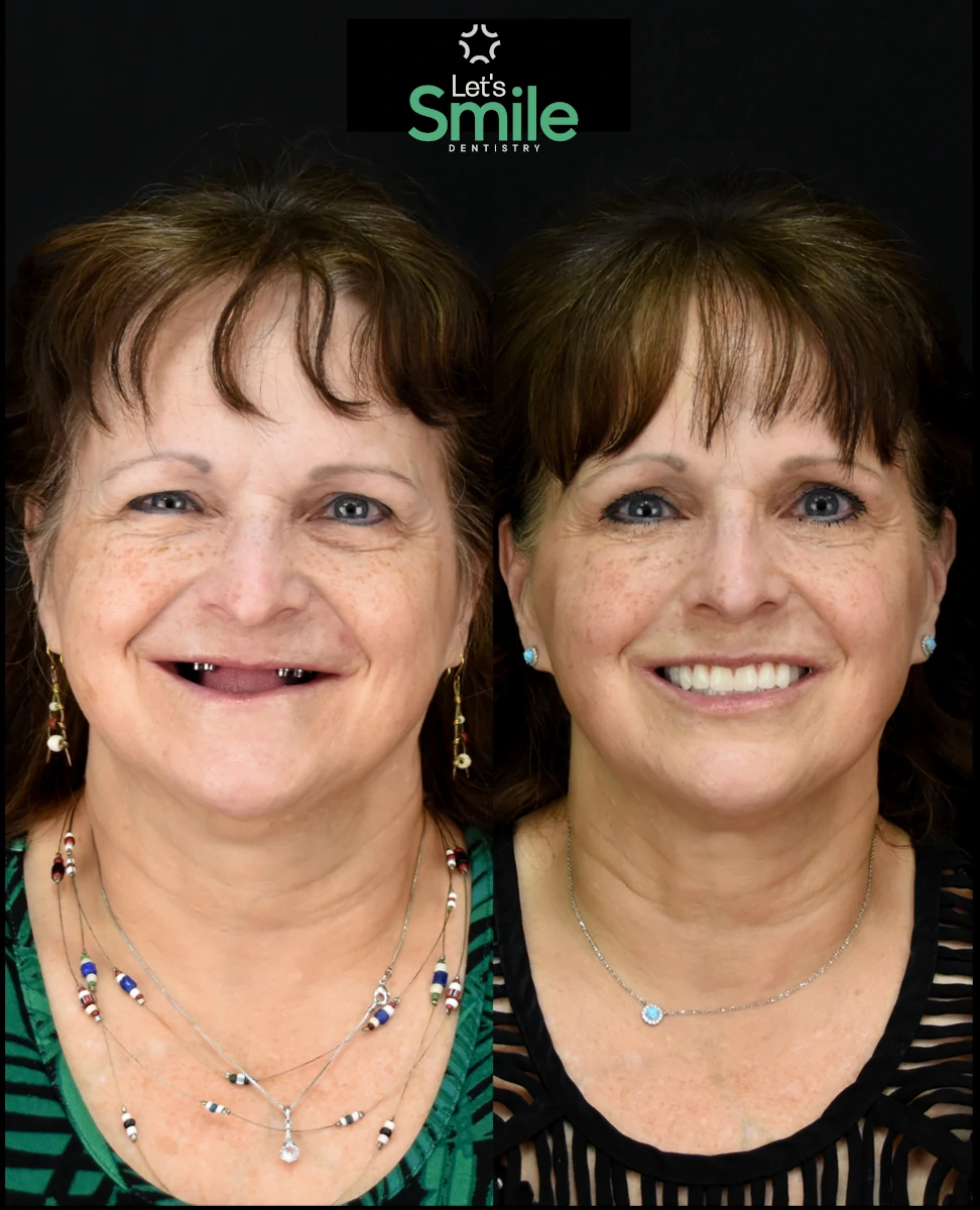 Before and after All-on-4/6 dental implant results at Let's Smile Dentistry in Mexicali