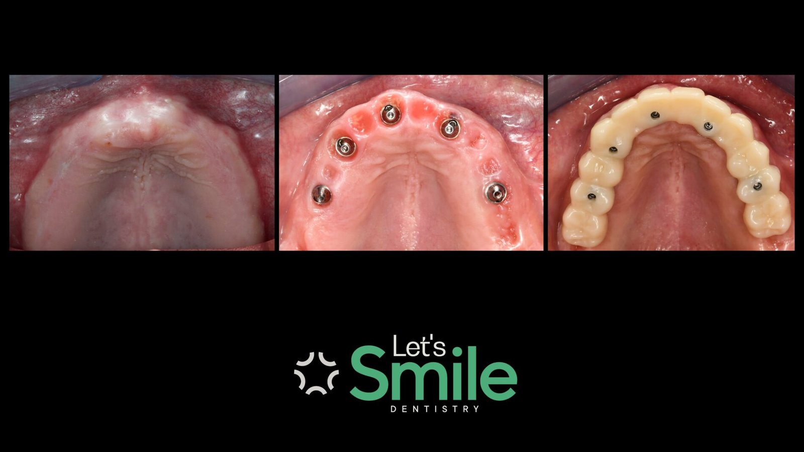 Step-by-step upper arch dental implant procedure showing edentulous ridge, multi-unit abutments, and final fixed hybrid prosthesis.