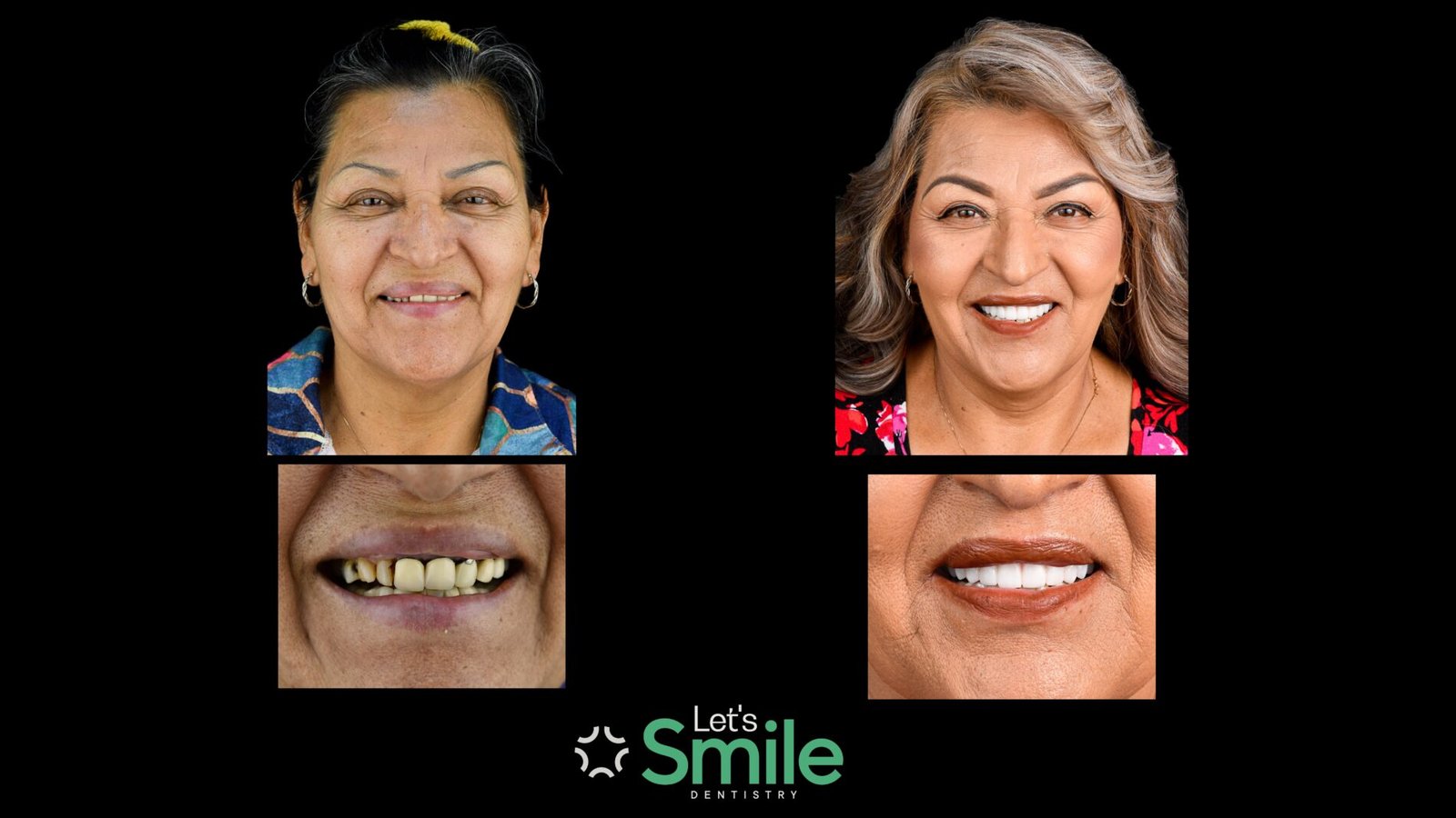 Full arch dental implants before and after results in Mexico, displaying a successful smile rehabilitation for an international patient at Let's Smile clinic.