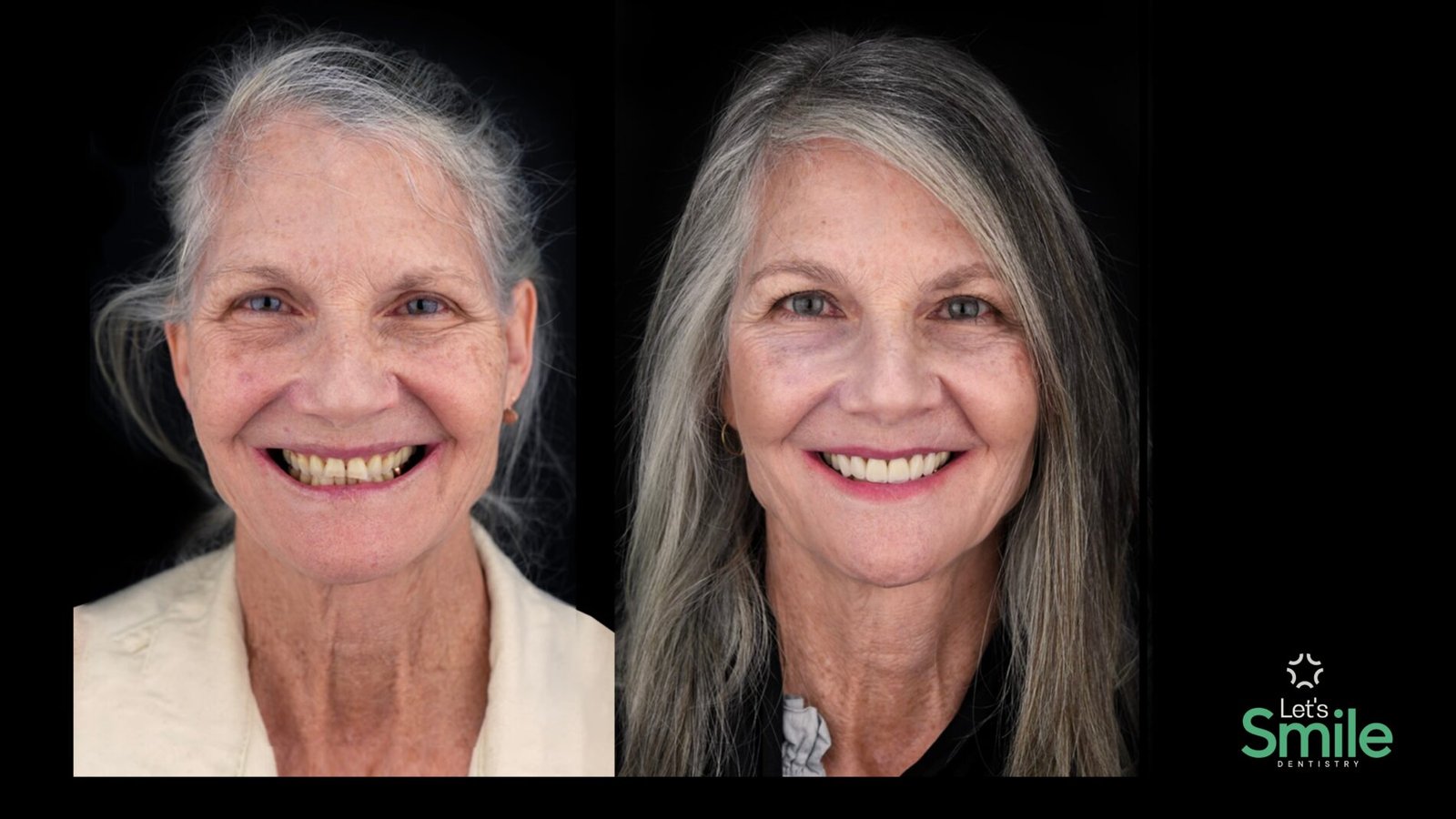Smile makeover before and after results in Mexico, displaying a successful full mouth rehabilitation for an international patient at Let's Smile clinic.