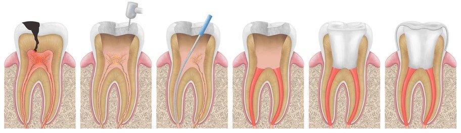 Dental root canal treatment diagram illustrating pulp infection removal, root canal cleaning, and tooth sealing with a dental crown.