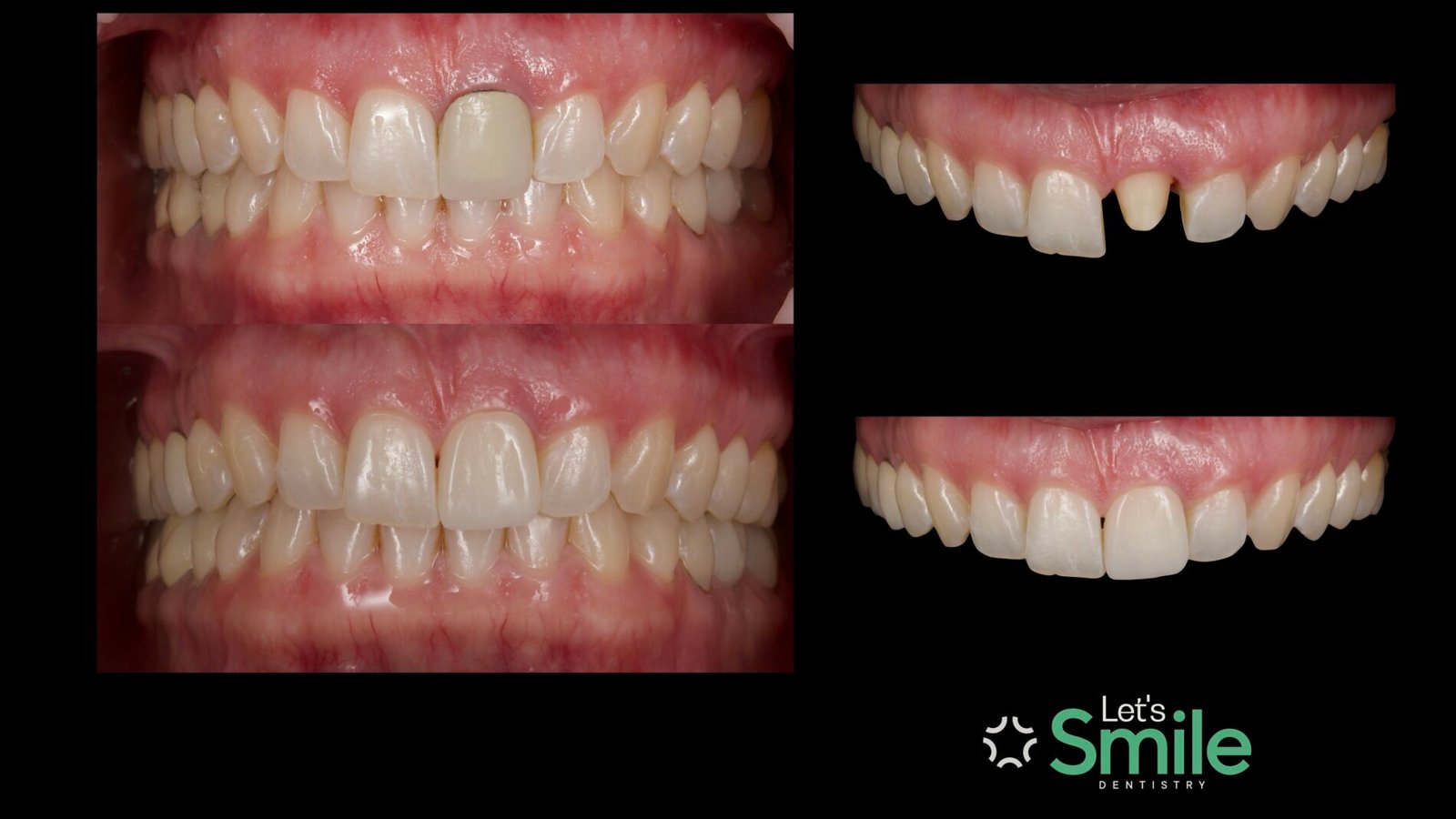 Dental crown before and after treatment case at Let's Smile Dentistry. The top images show a mismatched old dental crown with a dark metal line at the gumline and a prepared tooth stub. The bottom images showcase the final aesthetic porcelain crown restoration, perfectly matching the natural teeth and restoring a healthy smile.