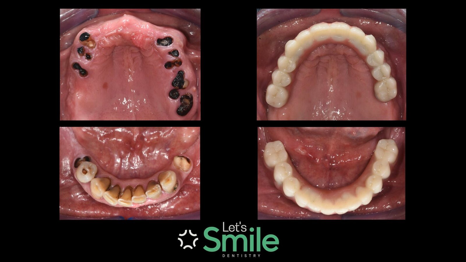 Occlusal view before and after full mouth dental implants treatment at Let's Smile Dentistry. The left images show top and bottom views of severely broken down roots and missing teeth. The right images display the precision-fit upper and lower implant-supported fixed bridges, highlighting perfect bite alignment and custom prosthetic distribution.