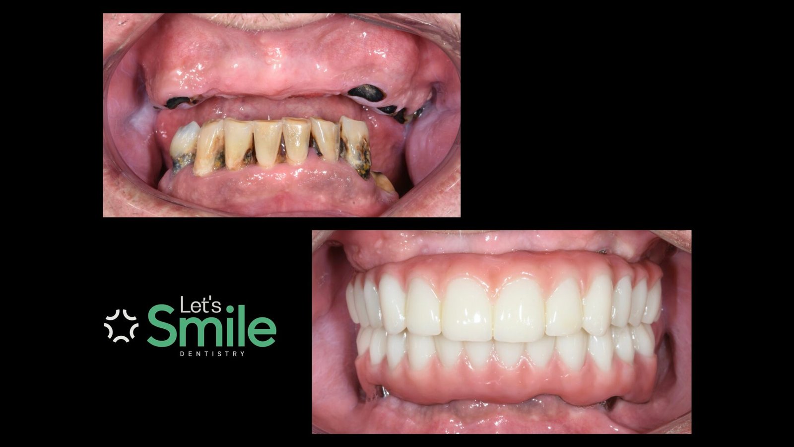 Before and after full mouth dental implants case at Let's Smile Dentistry. The top image shows severe tooth decay, missing upper teeth, and failing lower dentition. The bottom image displays the complete transformation with full-arch fixed implant-supported prosthetic bridges, restoring a healthy, natural-looking smile and function.