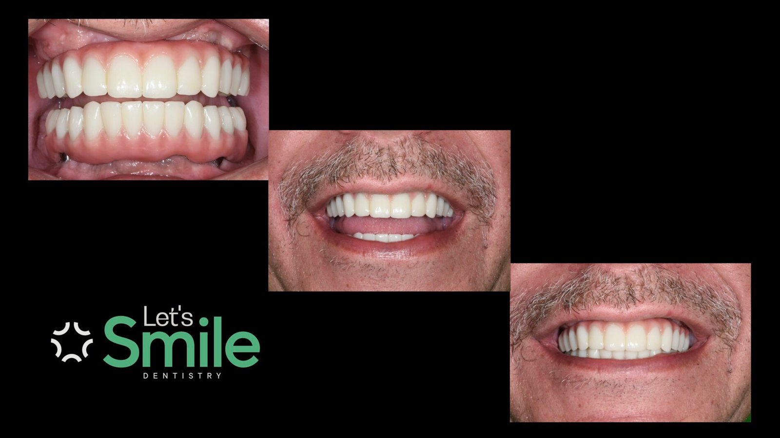 Full mouth dental implants clinical results at Let's Smile Dentistry in Mexicali. The image showcases close-up views of a male patient's natural-looking full-arch fixed prosthetic bridges attached to dental implants, perfectly restoring both upper and lower teeth, alongside his confident, healthy smile.