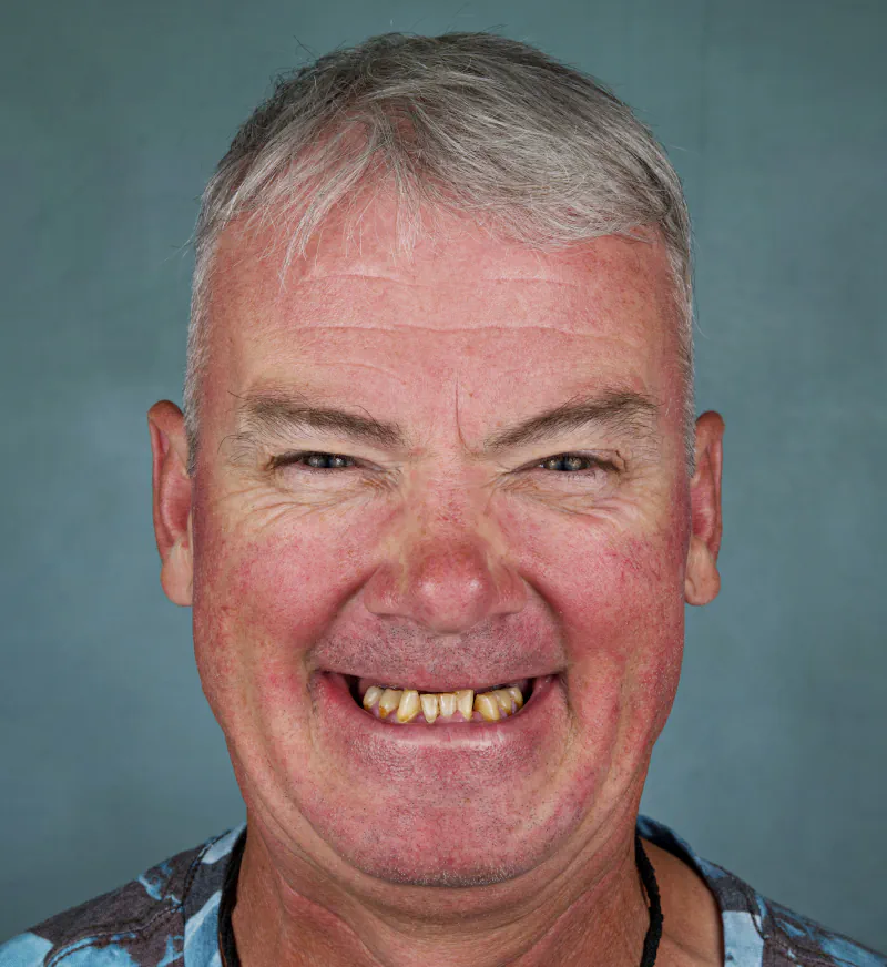 Ken before full-arch dental implants at Let’s Smile Dentistry, worn and missing teeth