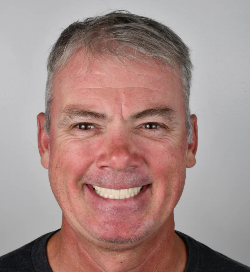 Ken after fixed full-arch dental implants at Let’s Smile Dentistry