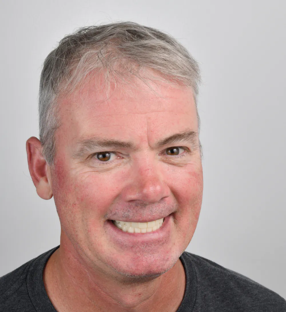 Ken smiling with his new full-arch implant teeth, restored at Let’s Smile Dentistry in Mexicali
