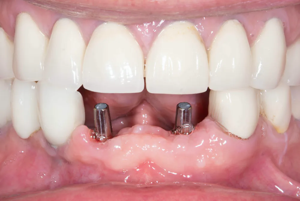Before: two anterior implant posts placed in the lower front arch at Let’s Smile Dentistry