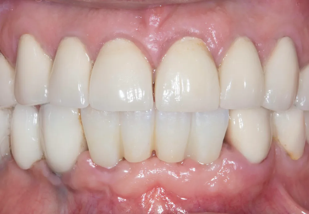 After: fixed anterior implant restoration completing the lower front teeth at Let’s Smile Dentistry