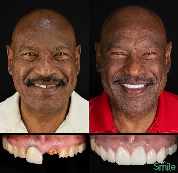 Before and after smile makeover collage for patient Charles Jones with full face portraits and close-up dental work at Let's Smile Dentistry in
  Mexicali, Mexico