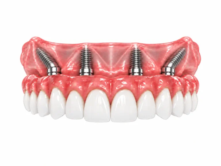 full one arch dental implants mexico