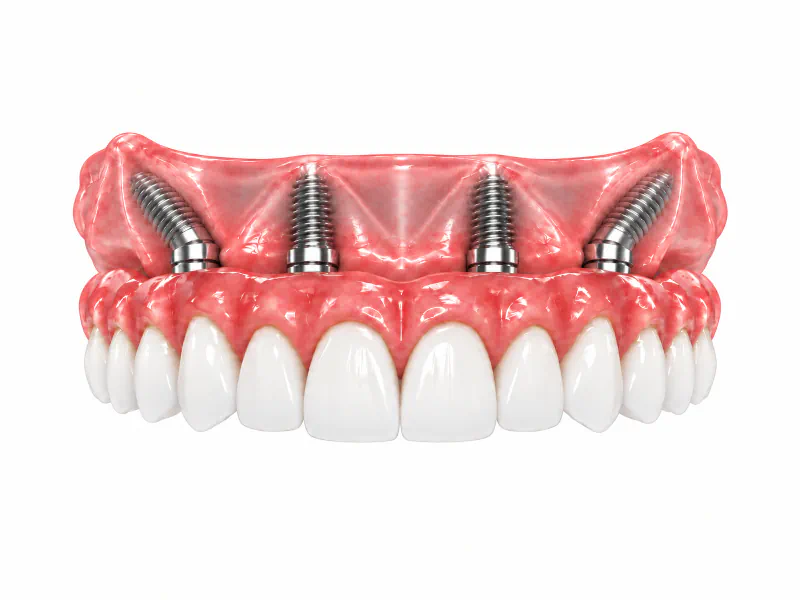 One arch All-on-4 dental implant model
