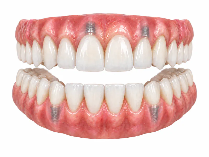 Full smile makeover with zirconia crowns model
