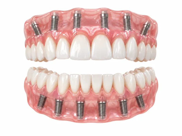 full two arch dental implants mexico