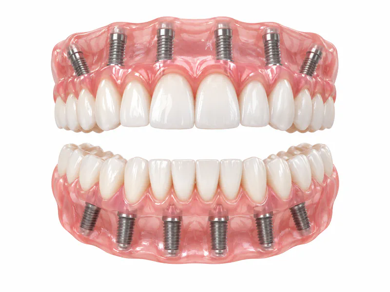 Top and bottom All-on-4 dental implant model