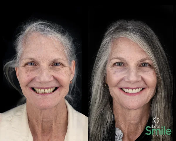 Before and after smile makeover dental work for patient Kathy at Let's Smile Dentistry in Mexicali, Mexico